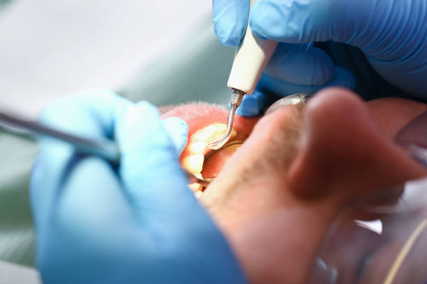 Best Chipped Tooth Repair Near Me  in Marion, VA